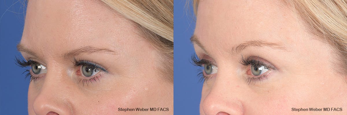 Brow Lift Before & After Gallery - Patient 354437 - Image 2