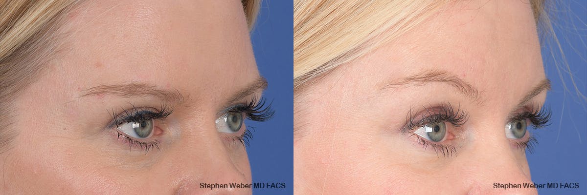 Brow Lift Before & After Gallery - Patient 354437 - Image 3