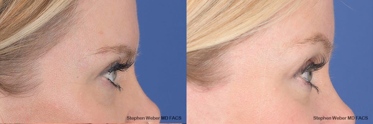 Brow Lift Before & After Gallery - Patient 354437 - Image 4