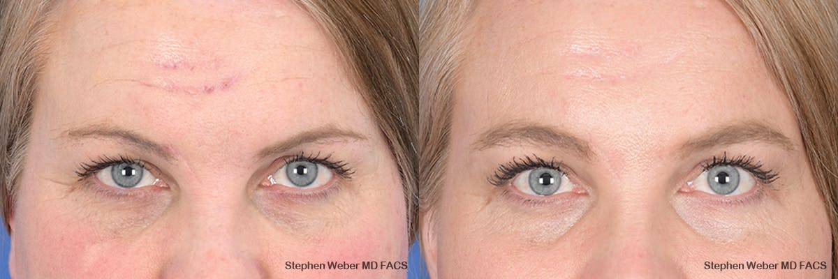 Brow Lift Before & After Gallery - Patient 166386 - Image 1