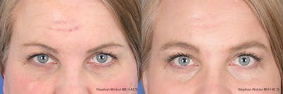 Brow Lift Before & After Gallery - Patient 166386 - Image 1