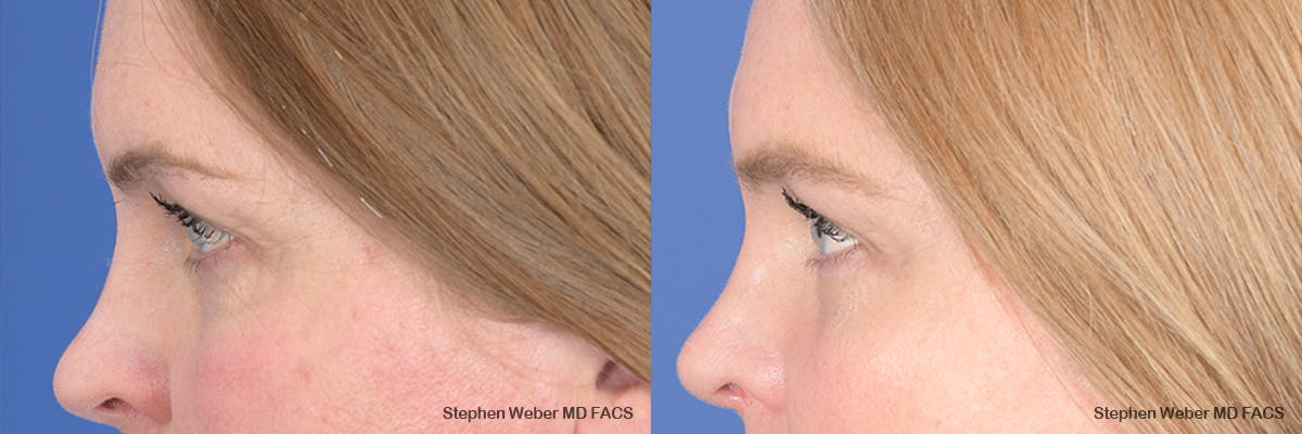 Brow Lift Before & After Gallery - Patient 166386 - Image 2