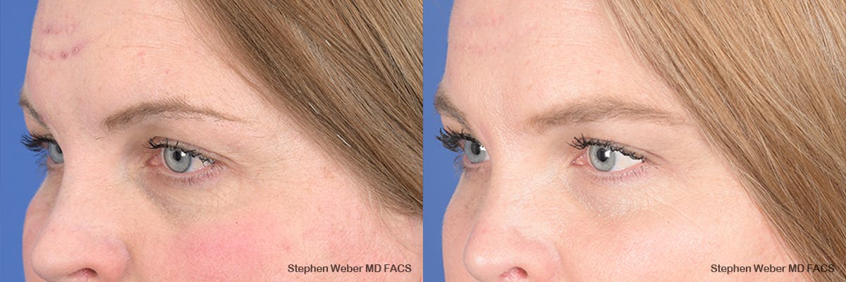 Brow Lift Before & After Gallery - Patient 166386 - Image 3