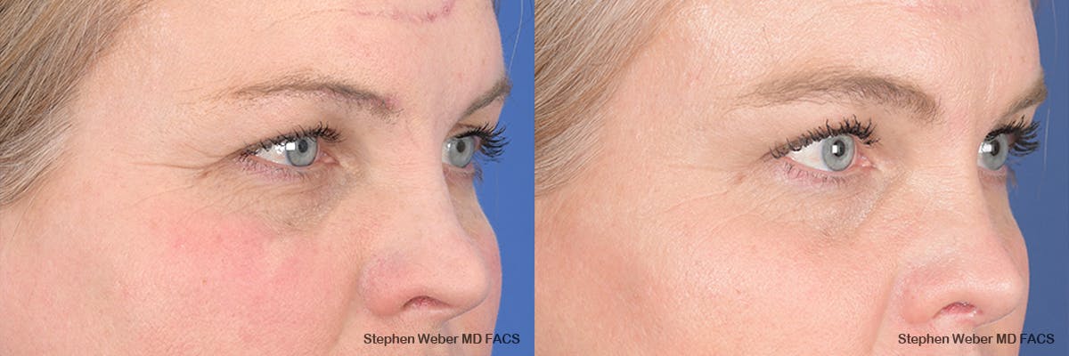 Brow Lift Before & After Gallery - Patient 166386 - Image 4