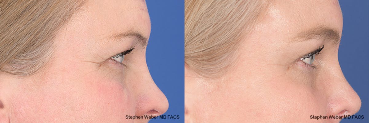 Brow Lift Before & After Gallery - Patient 166386 - Image 5