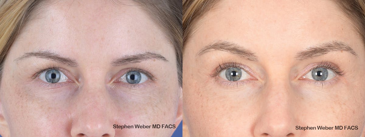 Brow Lift Before & After Gallery - Patient 181223 - Image 1