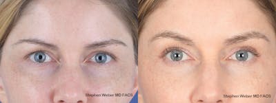 Brow Lift Before & After Gallery - Patient 181223 - Image 1