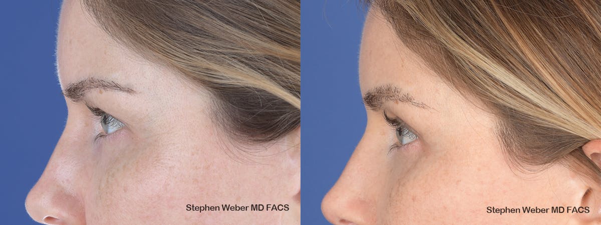 Brow Lift Before & After Gallery - Patient 181223 - Image 2