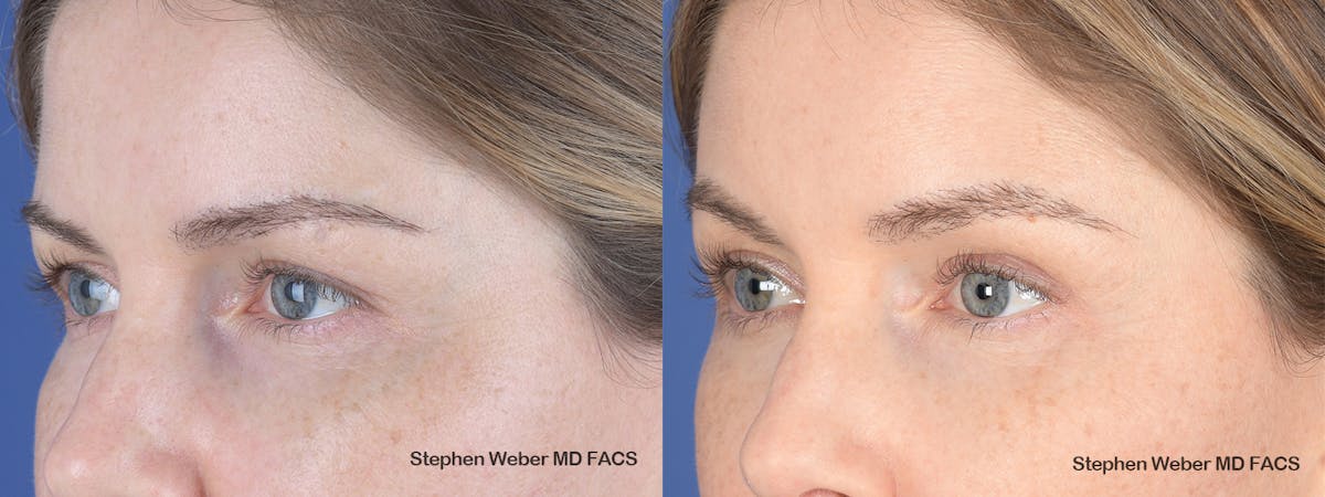 Brow Lift Before & After Gallery - Patient 181223 - Image 3