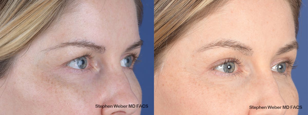 Brow Lift Before & After Gallery - Patient 181223 - Image 4
