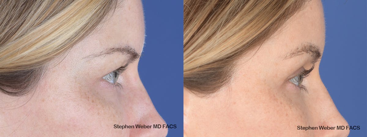 Brow Lift Before & After Gallery - Patient 181223 - Image 5