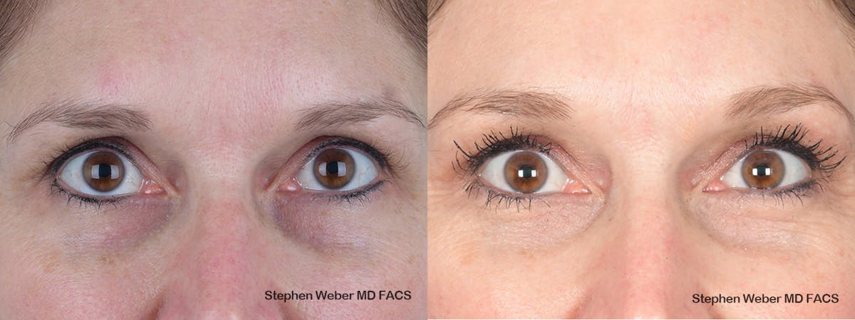 Brow Lift Before & After Gallery - Patient 405414 - Image 1