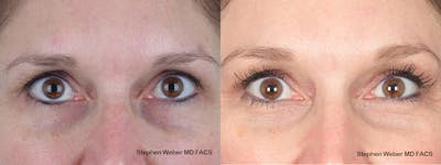 Brow Lift Before & After Gallery - Patient 405414 - Image 1