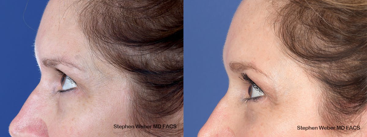 Brow Lift Before & After Gallery - Patient 405414 - Image 2