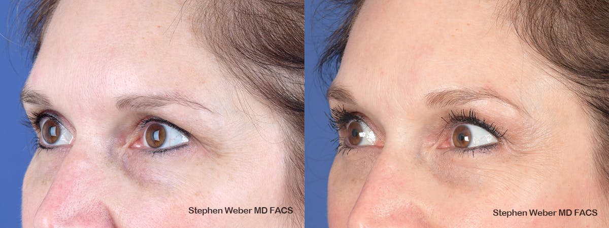 Brow Lift Before & After Gallery - Patient 405414 - Image 3