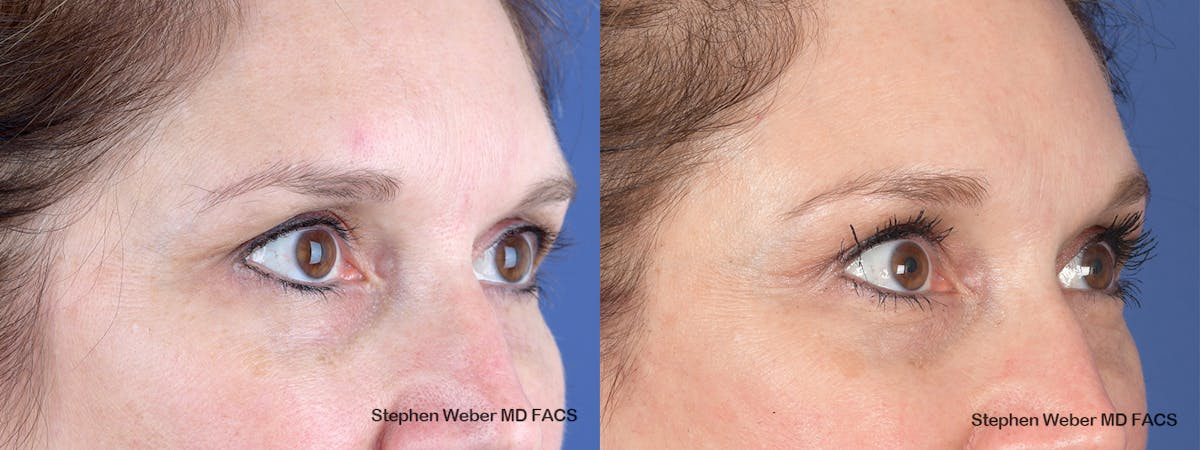 Brow Lift Before & After Gallery - Patient 405414 - Image 4