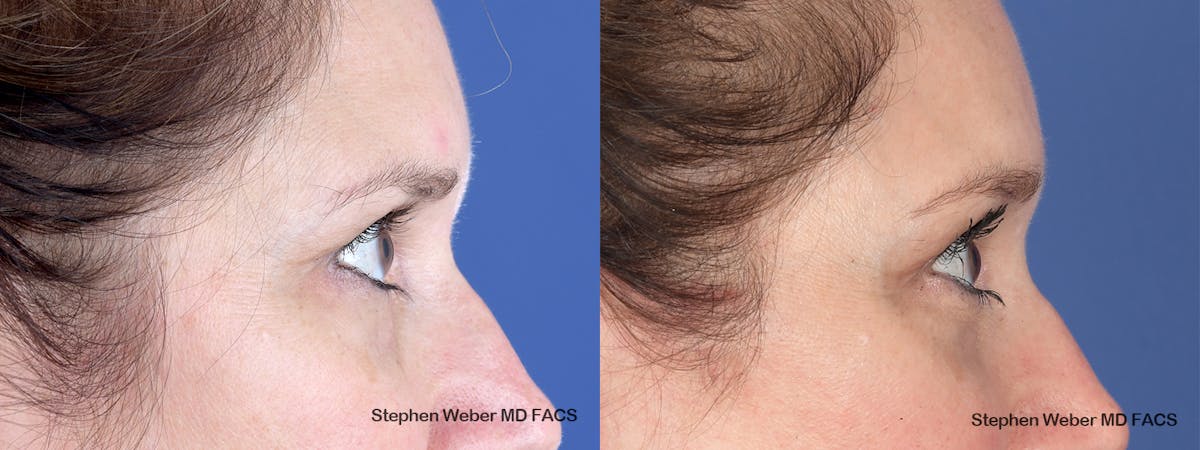 Brow Lift Before & After Gallery - Patient 405414 - Image 5
