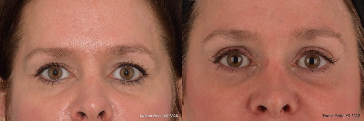 Brow Lift Before & After Gallery - Patient 329778 - Image 1