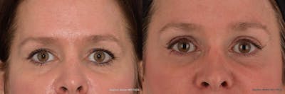 Brow Lift Before & After Gallery - Patient 329778 - Image 1