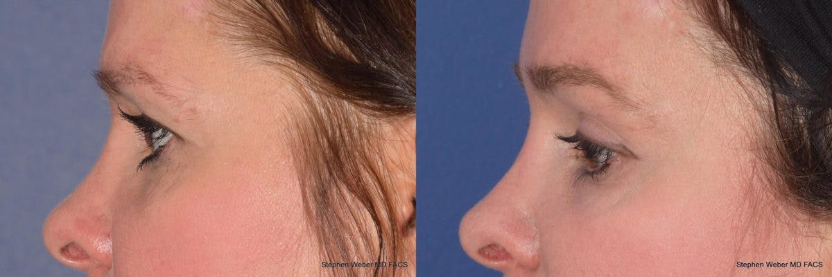 Brow Lift Before & After Gallery - Patient 329778 - Image 2