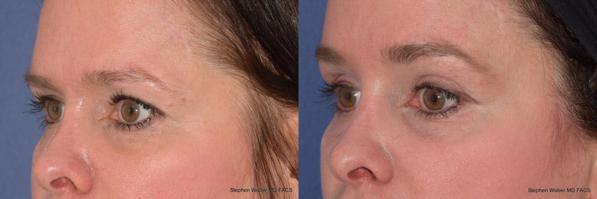 Brow Lift Before & After Gallery - Patient 329778 - Image 3