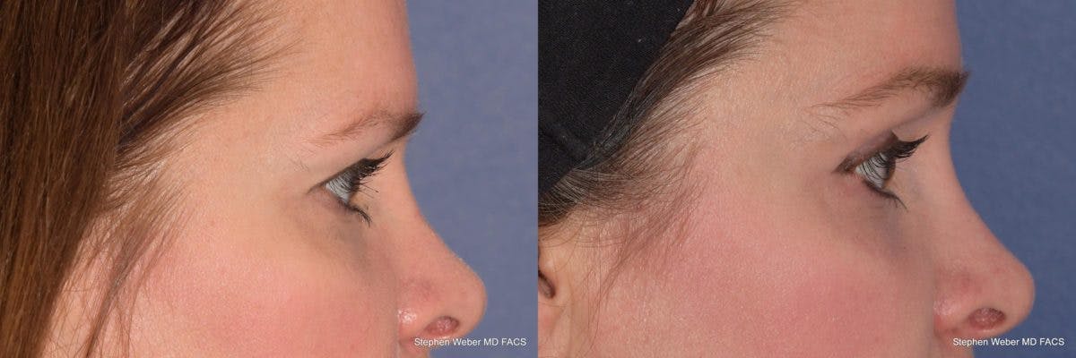 Brow Lift Before & After Gallery - Patient 329778 - Image 4