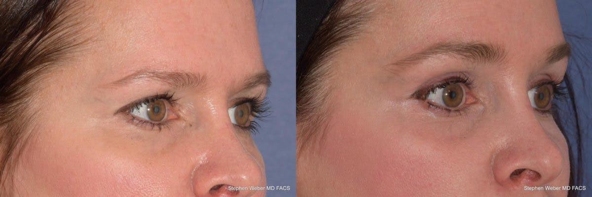 Brow Lift Before & After Gallery - Patient 329778 - Image 5