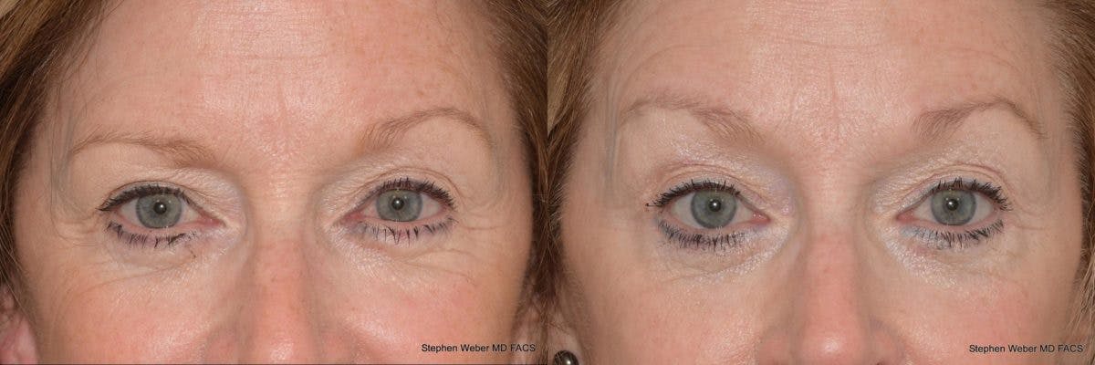 Brow Lift Before & After Gallery - Patient 132863 - Image 1
