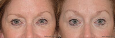 Brow Lift Before & After Gallery - Patient 132863 - Image 1