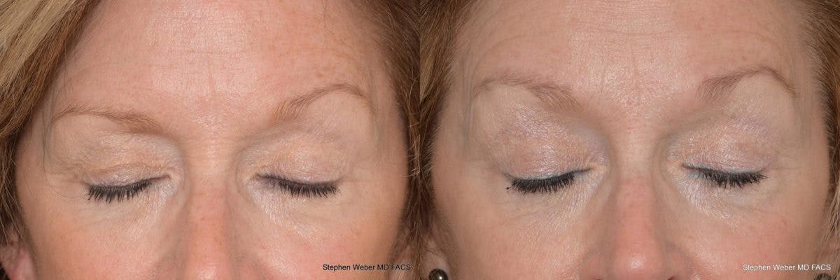 Brow Lift Before & After Gallery - Patient 132863 - Image 2