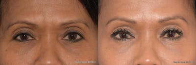 Brow Lift Before & After Gallery - Patient 303618 - Image 1