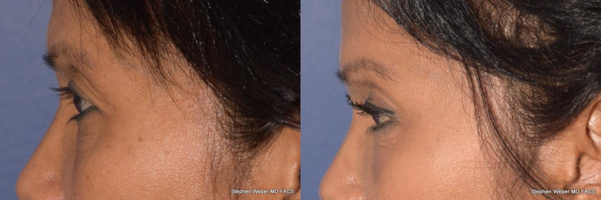 Brow Lift Before & After Gallery - Patient 303618 - Image 2