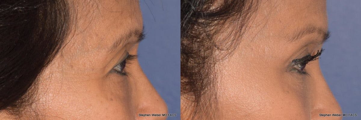 Brow Lift Before & After Gallery - Patient 303618 - Image 3