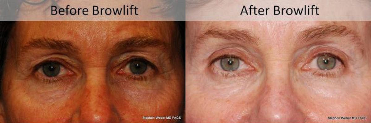 Brow Lift Before & After Gallery - Patient 383799 - Image 1