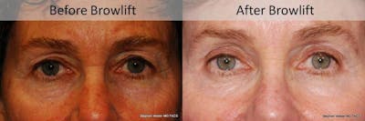 Brow Lift Before & After Gallery - Patient 383799 - Image 1