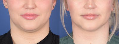 Buccal Fat Removal Before & After Gallery - Patient 141390 - Image 1
