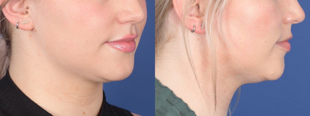 Buccal Fat Removal Before & After Gallery - Patient 141390 - Image 2
