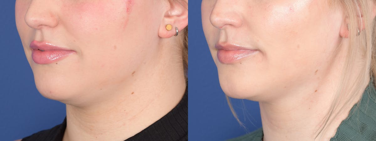 Buccal Fat Removal Before & After Gallery - Patient 141390 - Image 3