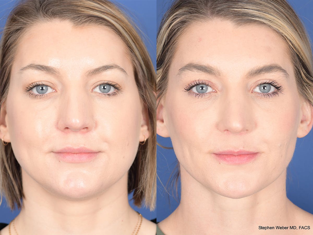 Buccal Fat Removal Before & After Gallery - Patient 390378 - Image 1