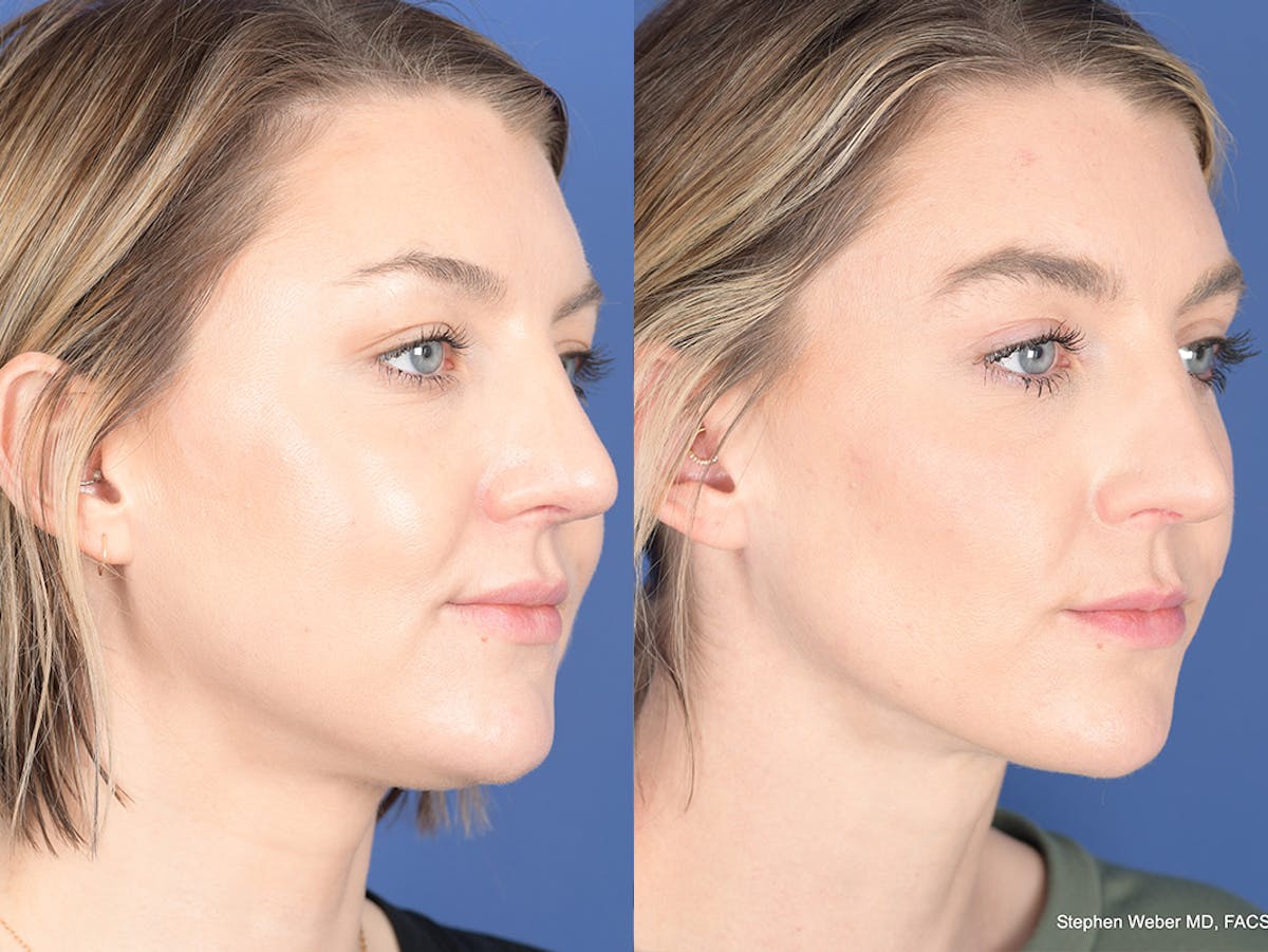Buccal Fat Removal Before & After Gallery - Patient 390378 - Image 2
