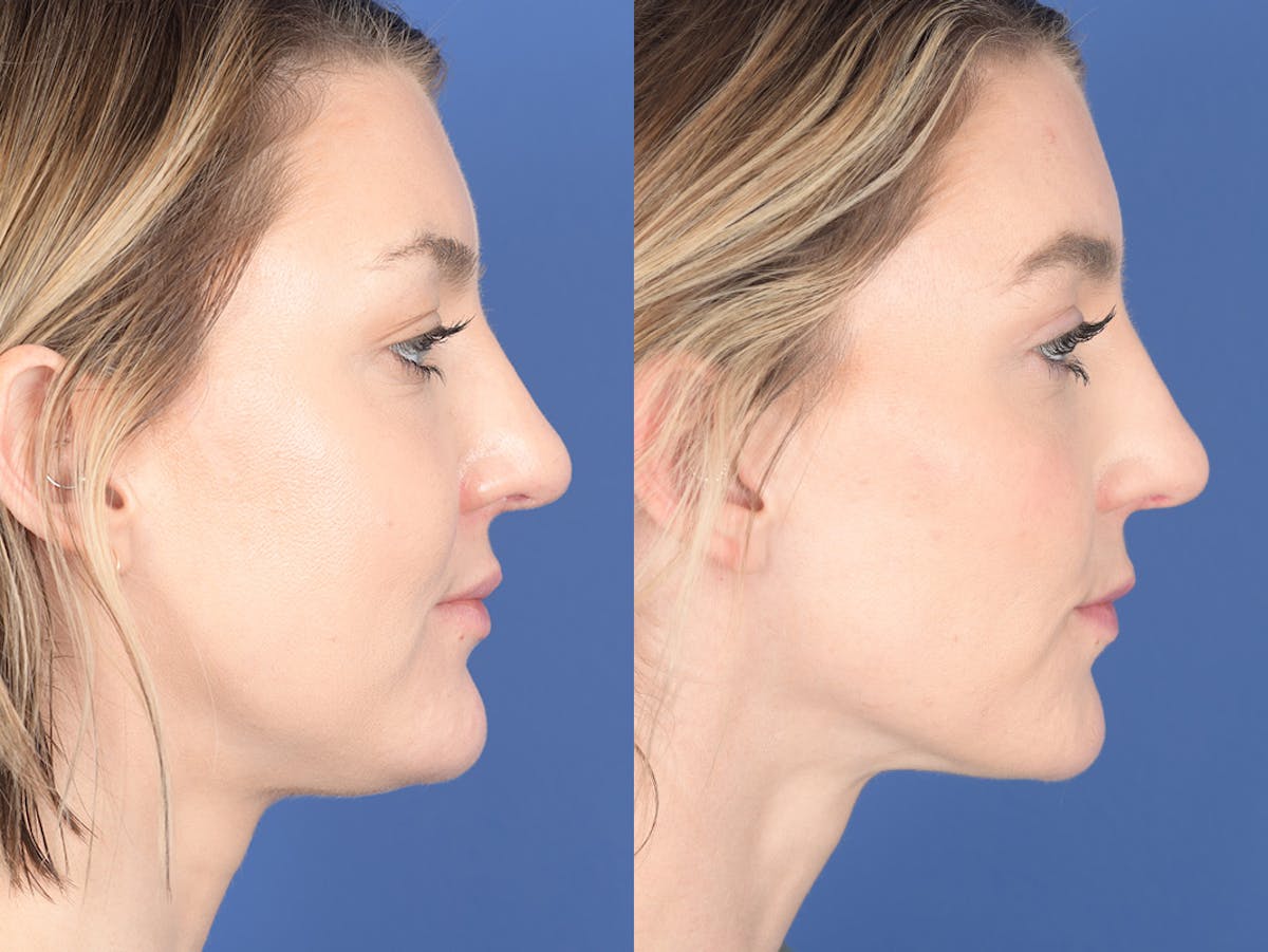 Buccal Fat Removal Before & After Gallery - Patient 390378 - Image 3