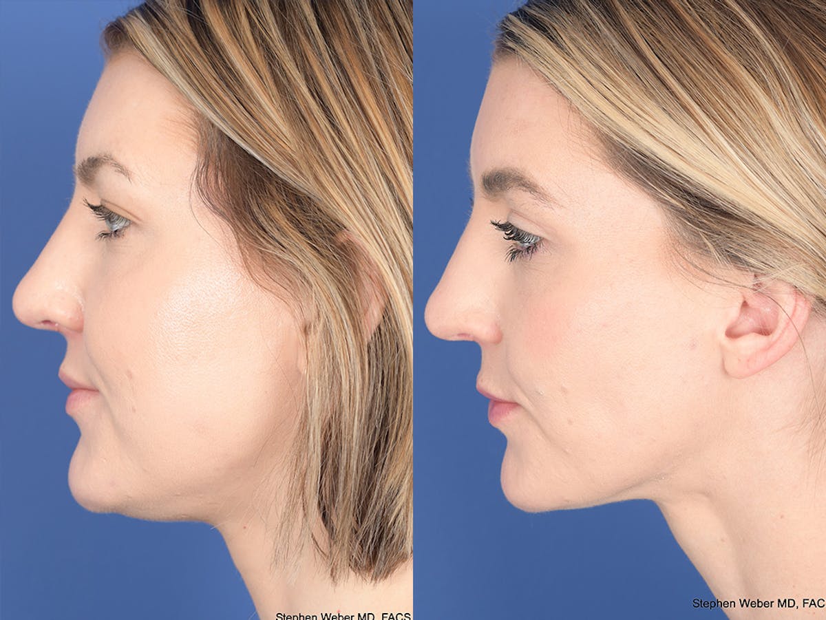 Buccal Fat Removal Before & After Gallery - Patient 390378 - Image 4