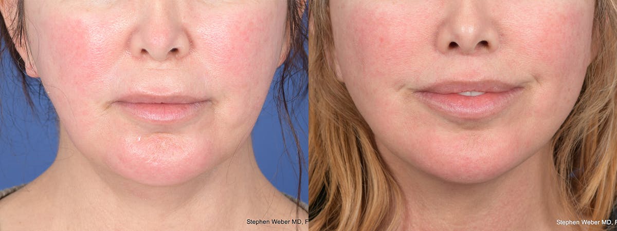 Buccal Fat Removal Before & After Gallery - Patient 206222 - Image 1