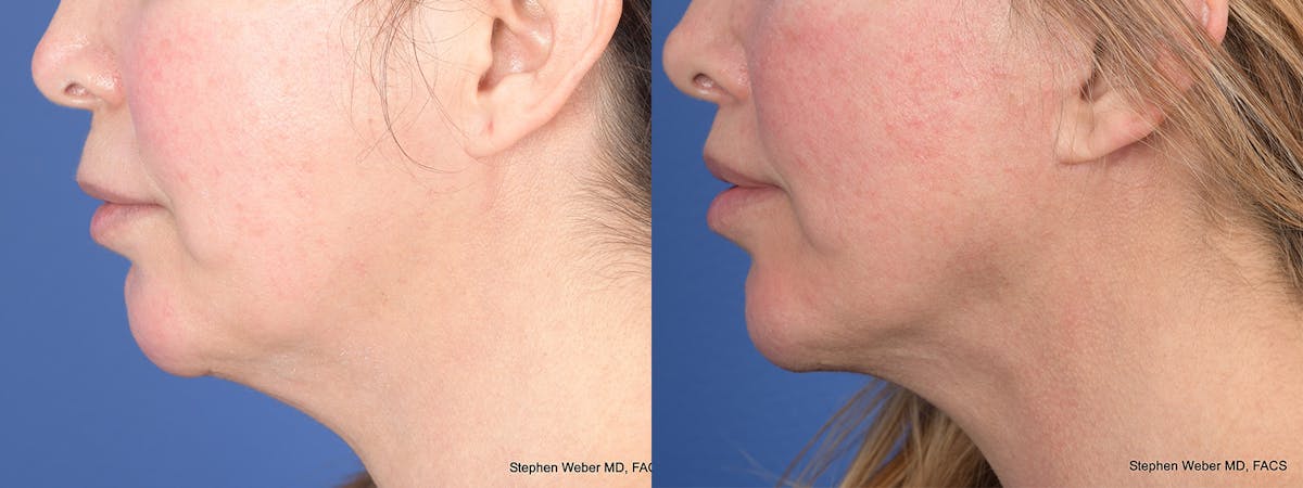 Buccal Fat Removal Before & After Gallery - Patient 206222 - Image 3