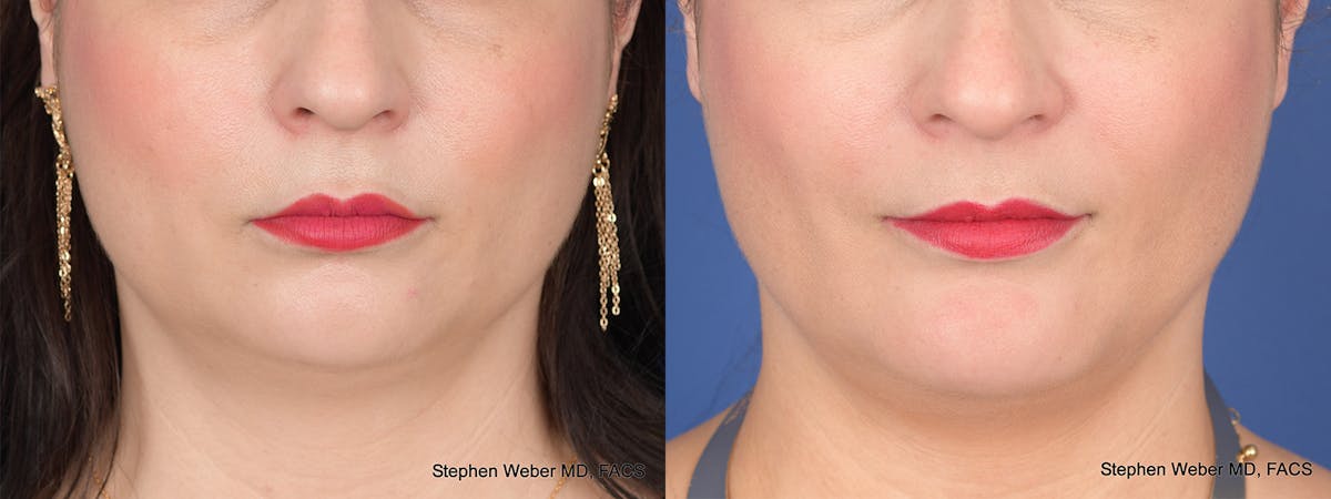 Buccal Fat Removal Before & After Gallery - Patient 680799 - Image 1