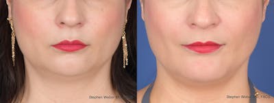 Buccal Fat Removal Before & After Gallery - Patient 680799 - Image 1