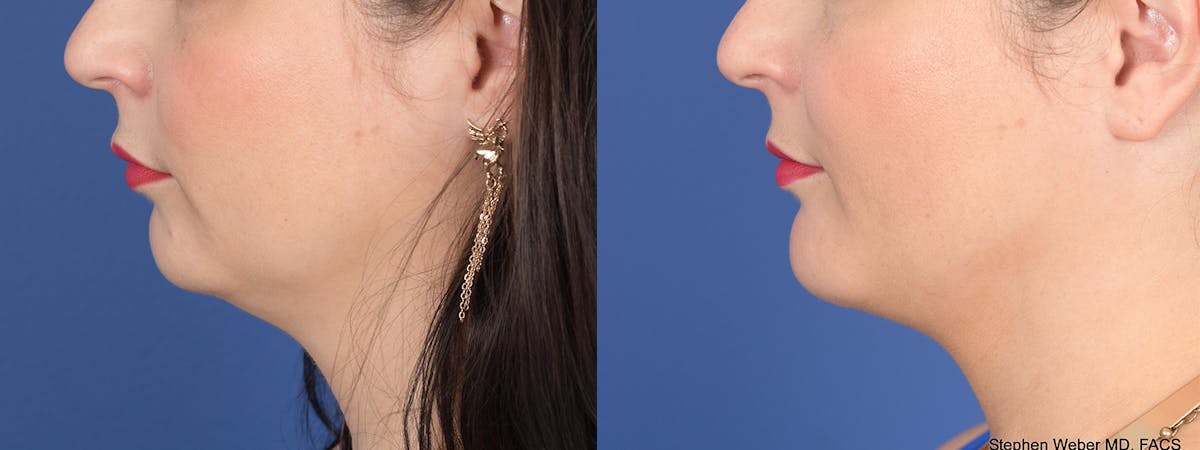 Buccal Fat Removal Before & After Gallery - Patient 680799 - Image 2