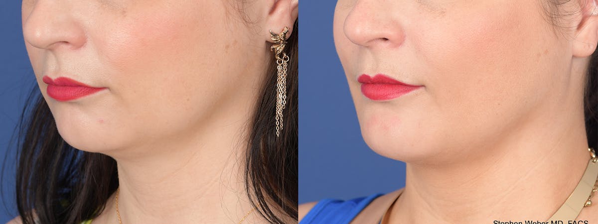 Buccal Fat Removal Before & After Gallery - Patient 680799 - Image 3