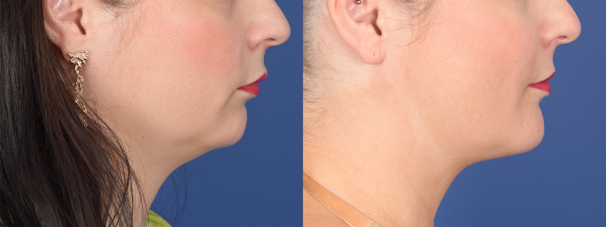 Buccal Fat Removal Before & After Gallery - Patient 680799 - Image 4