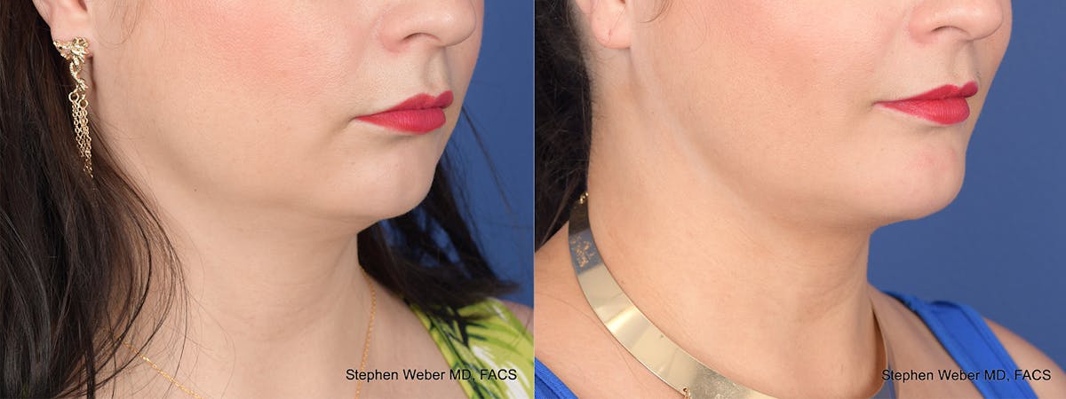Buccal Fat Removal Before & After Gallery - Patient 680799 - Image 5